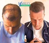 Hair Transplantation Clinic ( Planting Equipment )