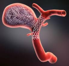 Aneurysm Coiling: Modern Care, Faster Recovery, Better Outcomes ( Fre