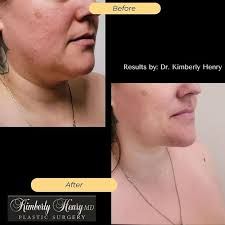 Best Breast Augmentation Roseville ( Business For Sale )